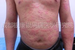 75��Ƥ��������Ƥм˵���ټ���